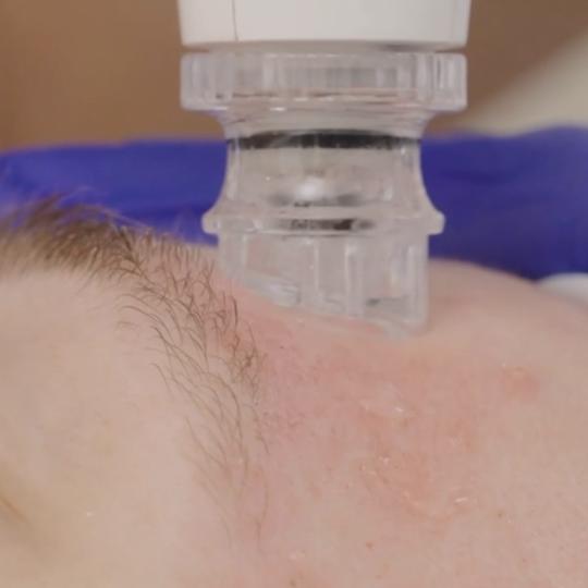 Luxelumíe #zagreb Tretman lica Hydrafacial tretman lica + vrata U Hydrafacial tretmanu koriste se s