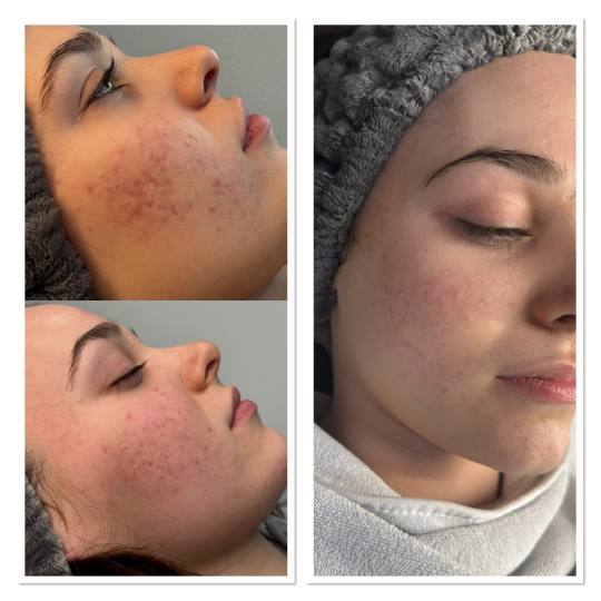 Luma Medic #zagreb Tretman lica SQT resurfacing