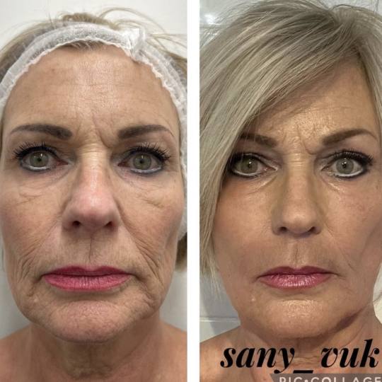 Sany Nails & Cosmetics #zagreb Tretman lica  ACCOR Cosmetics Corrector je nježna alternativa operac