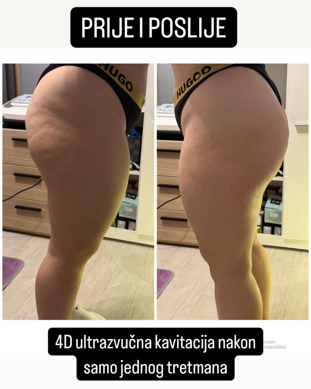 Nirvana Life Therapy #zagreb Anticelulit 4D Kavitacija + gratis presoterapija