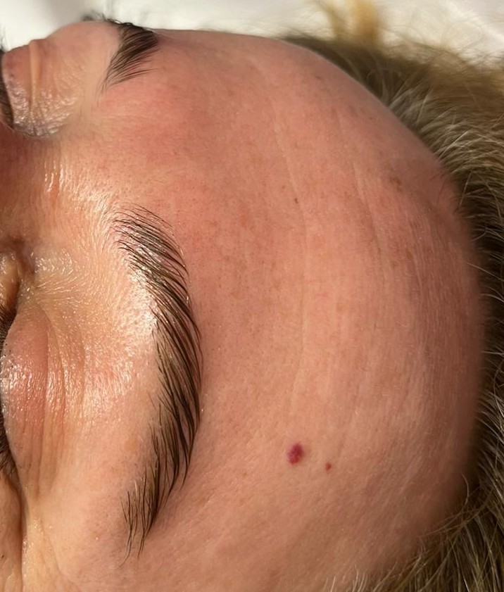 Brow lift - SolGabi, Zlatar Obrve Lice Obrve, Zlatar, Centar