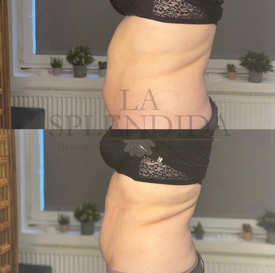 La Splendida #velika-gorica Anticelulit Ultimate Slim