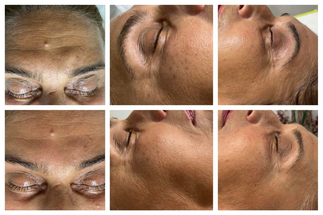 Virtualna mezoterapija - Mesofiller - Loops, Viškovo Mezoterapija lica Lice Mezoterapija lica, Viškovo, Centar