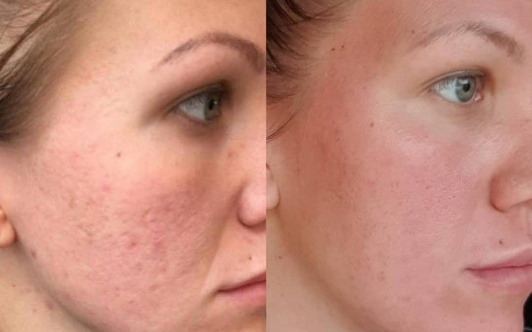 Perfect body beauty bar #zagreb Dermaroler i dermapen Dermapen exosomi - lice