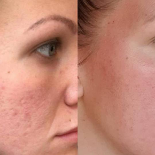 Perfect body beauty bar #zagreb Dermaroler i dermapen Dermapen exosomi - lice Nakon 2 dolaska,bolja 