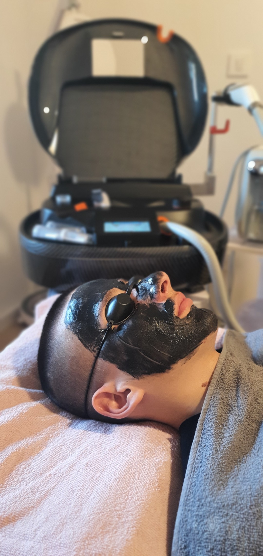 SOLO Beauty Centar #zagreb Laserski tretmani lica Black Doll -carbon peel