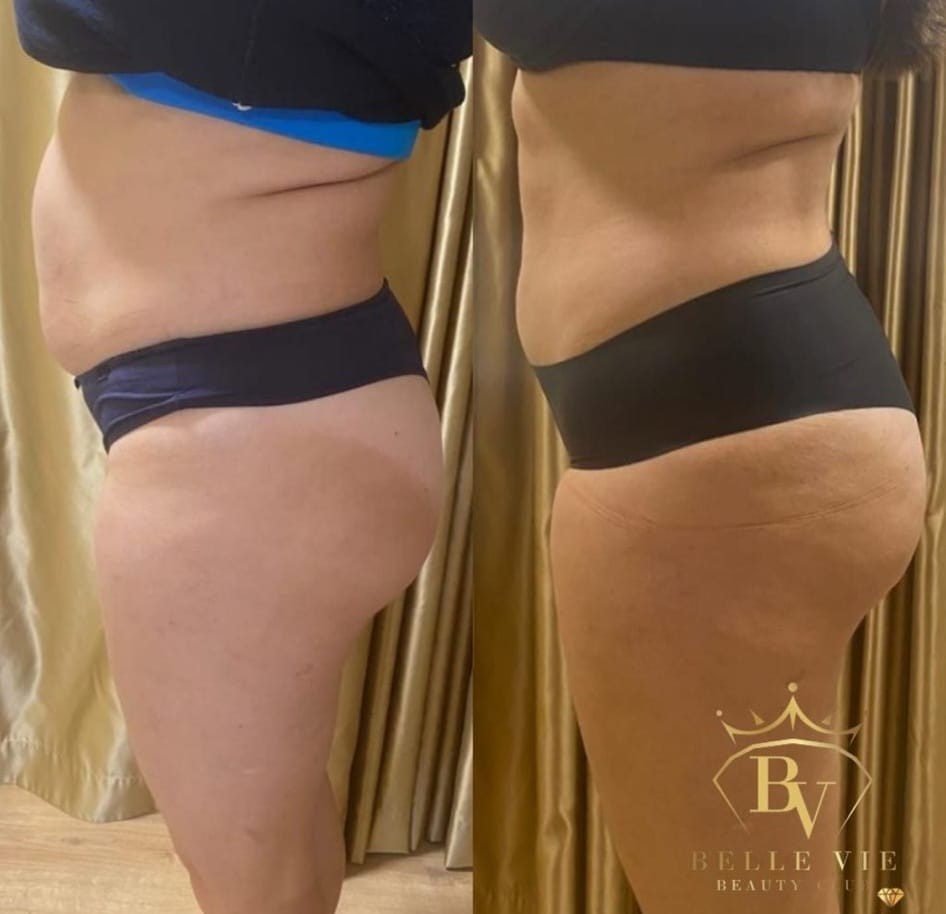 Belle Vie Beauty Club #zagreb Tretmani tijela Tesla tretman