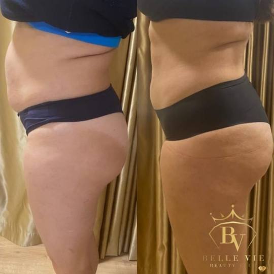 Belle Vie Beauty Club #zagreb Tretmani tijela Tesla tretman