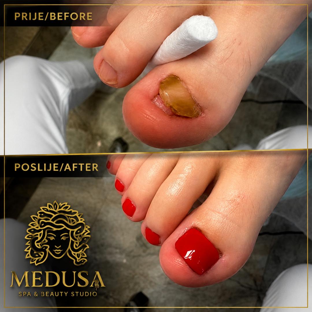 Medusa #osijek Medicinska pedikura Lift Up gel uraslog nokta - 1 palac