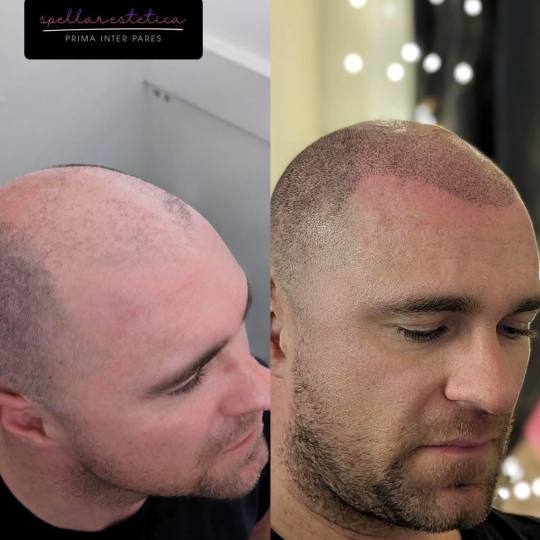 Spellar - Križ #kriz Mikro pigmentacija skalpa - cijena na upit