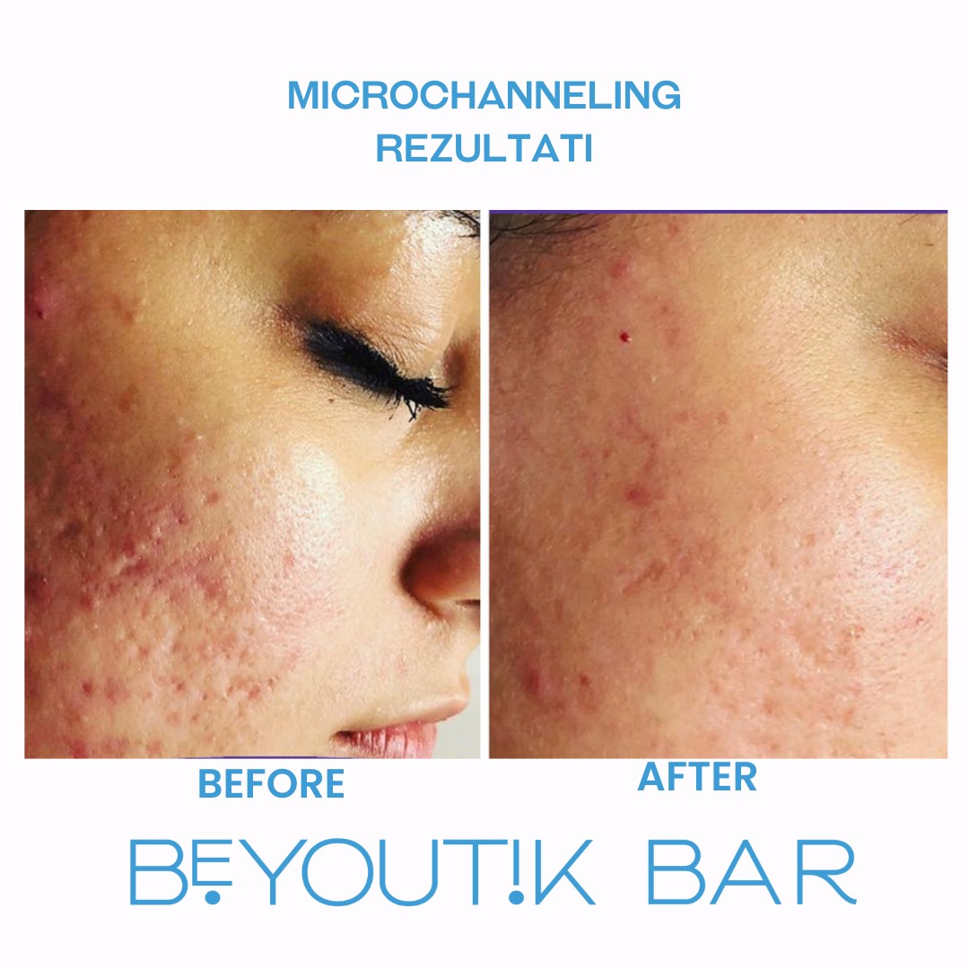BeYoutik Bar #zagreb Tretman lica Microchanneling - lice