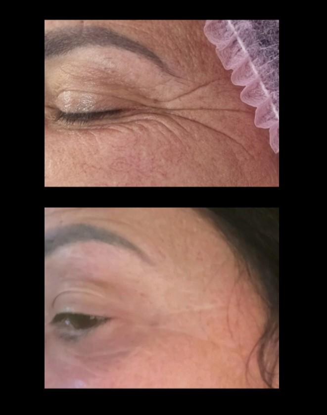 Beauty Studio Ariya #lovran Lifting / zatezanje kože GINSENG tretman,revitalizija