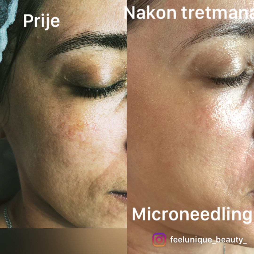 FeelUnique #zagreb Tretman lica Unitone neuro therapy - uklanjanje hiperpigmentacija