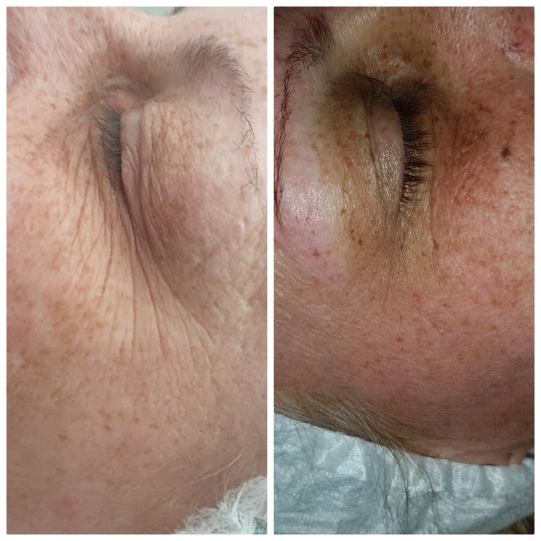 Melanis i Silueta studio za njegu lica i tijela #zagreb Tretman lica Mezoterapija lica + dermaroler - 5 tretmana