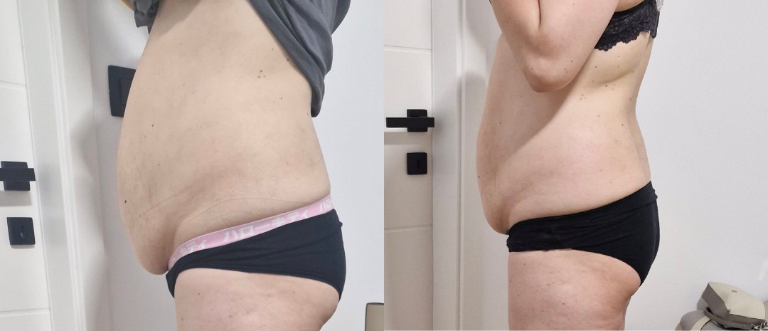 Barbara #zagreb Tretmani tijela Ultrazvučna kavitacija + vakuum masaža