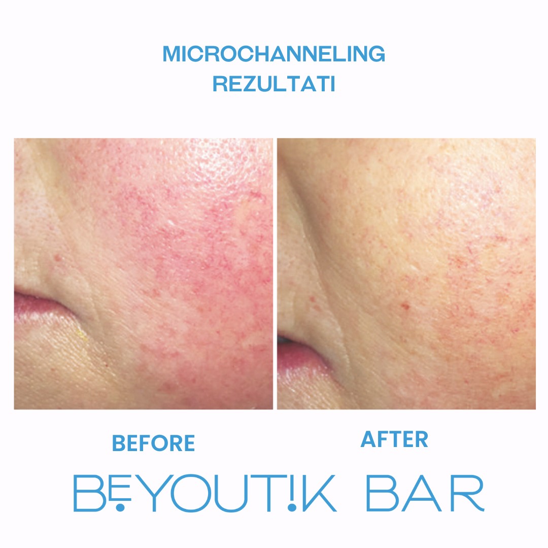 BeYoutik Bar #zagreb Tretman lica Microchanneling - lice