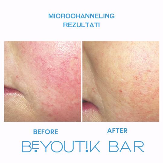 BeYoutik Bar #zagreb Tretman lica Microchanneling - lice *Napomena: Svaka koža je drugačija i potr
