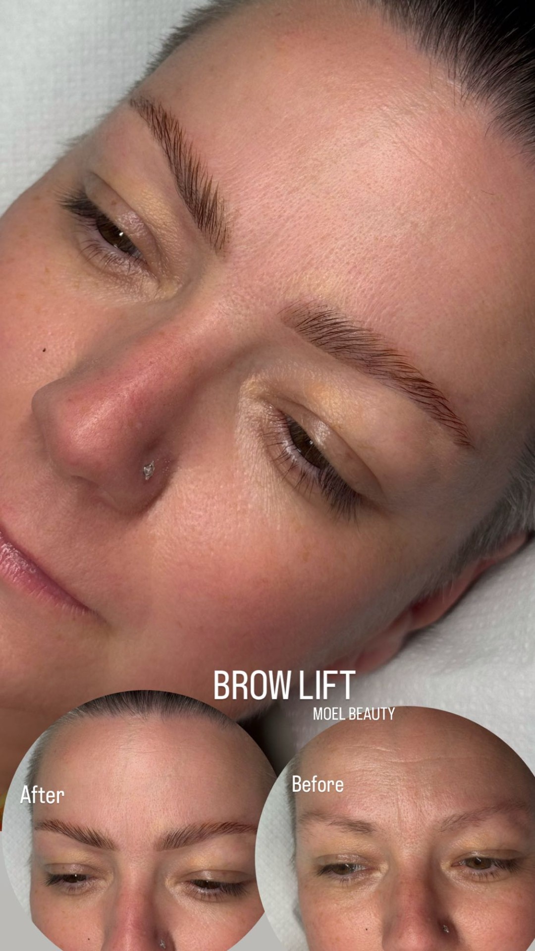 Brow lift + 3D filler - MOELL beauty, Zagreb Obrve Lice Obrve, Zagreb, Peščenica – Žitnjak
