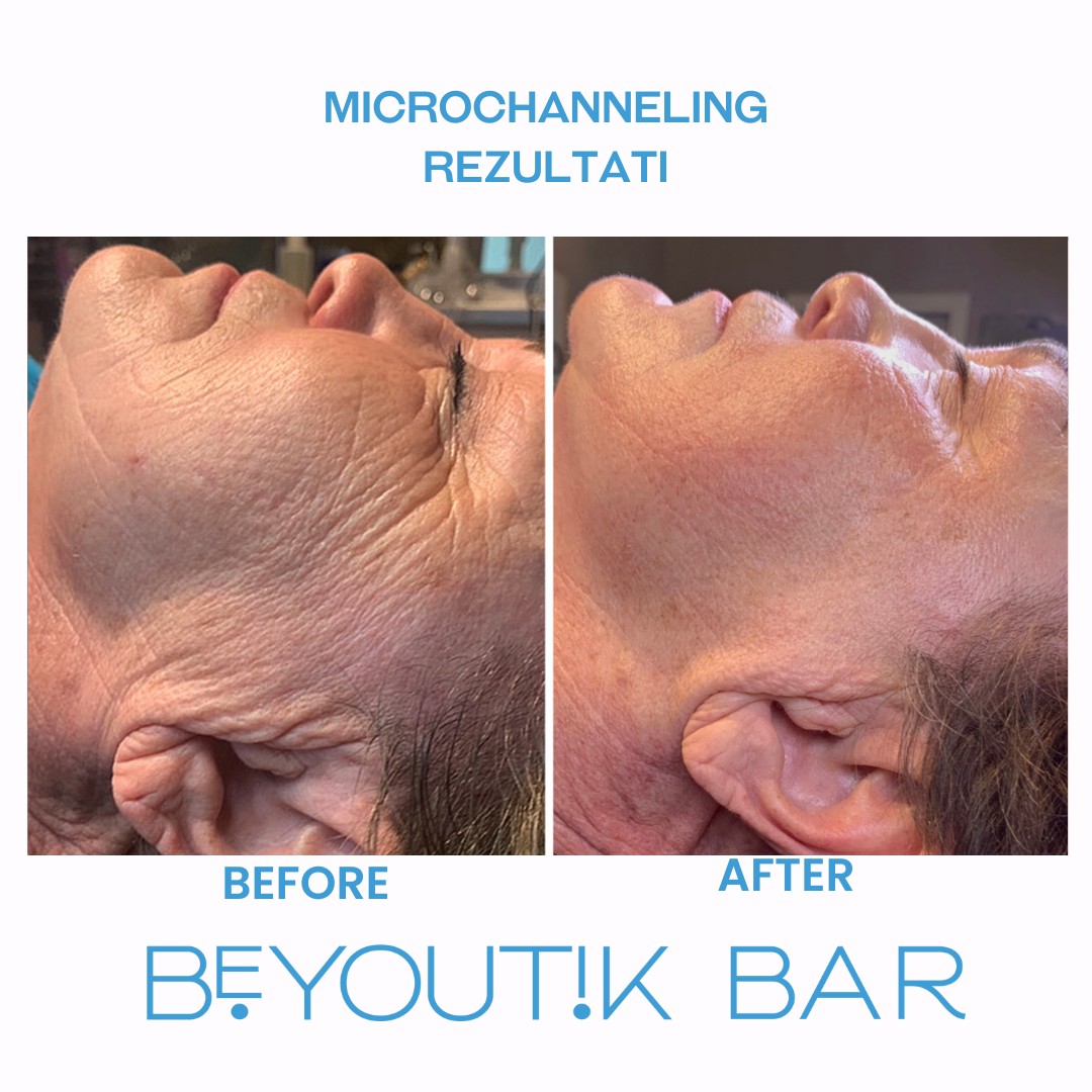 BeYoutik Bar #zagreb Tretman lica Microchanneling - lice