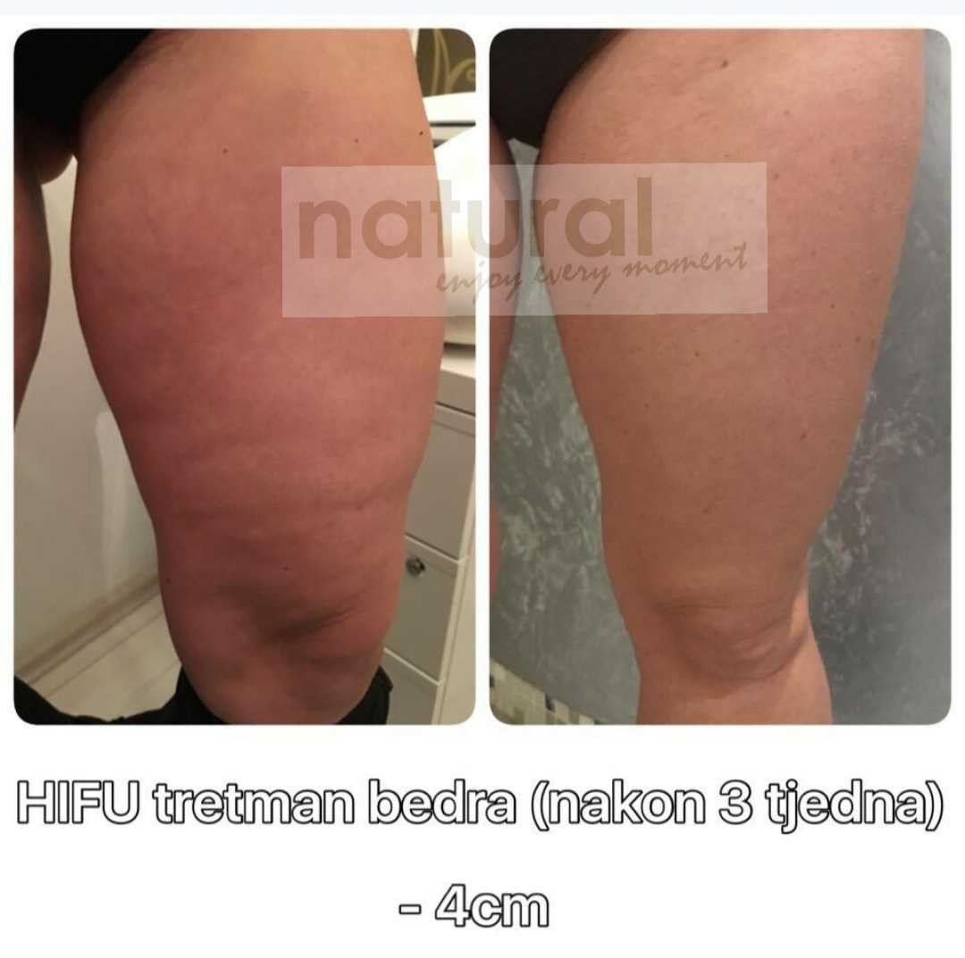 Natural #rijeka Tretman lica HIFU tretman bedra