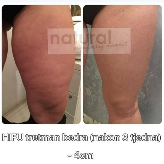 Natural #rijeka Tretman lica HIFU tretman bedra