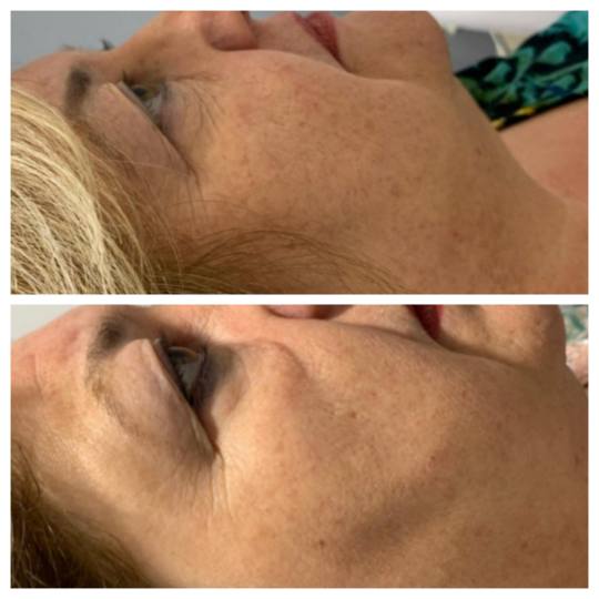 Antiage beauty room Lady Goga #zagreb Tretman lica