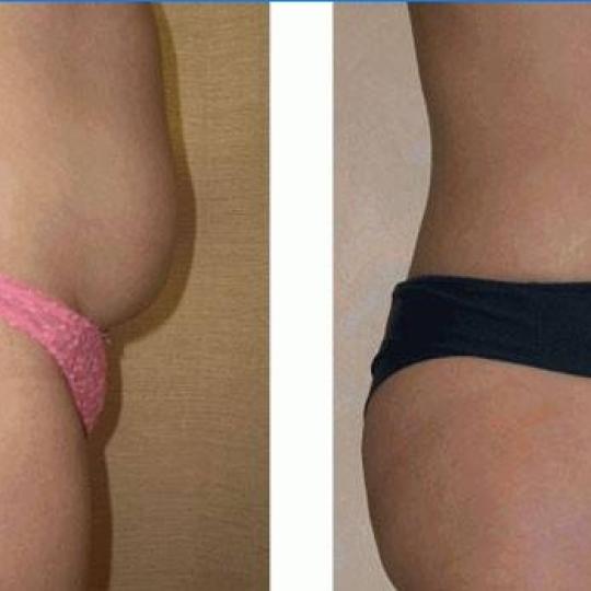 Perfect body beauty bar #zagreb 1 Kavitacija/1vacuum Sculpt 72