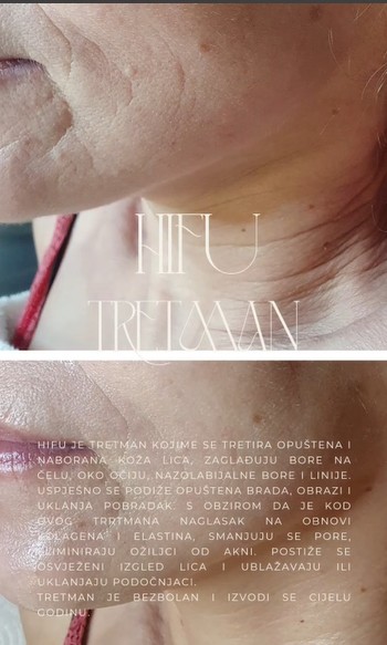 Perla #cakovec Tretman lica HIFU tretman - cijelo lice + podbradak + vrat