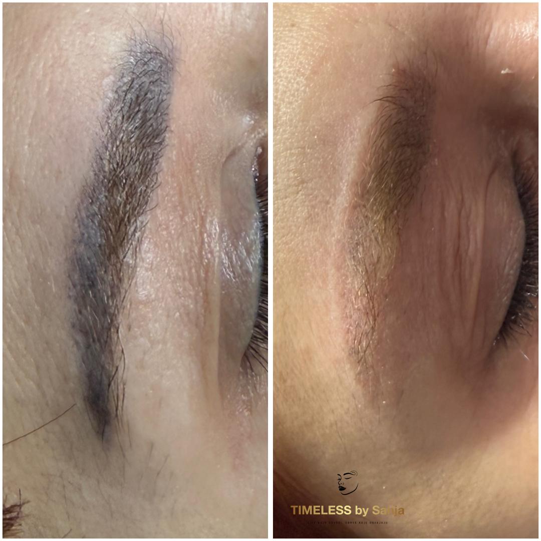 Lasersko uklanjanje obrva - Timeless by Sanja, Zagreb Uklanjanje tetovaža Tijelo Uklanjanje tetovaža, Zagreb, Peščenica – Žitnjak
