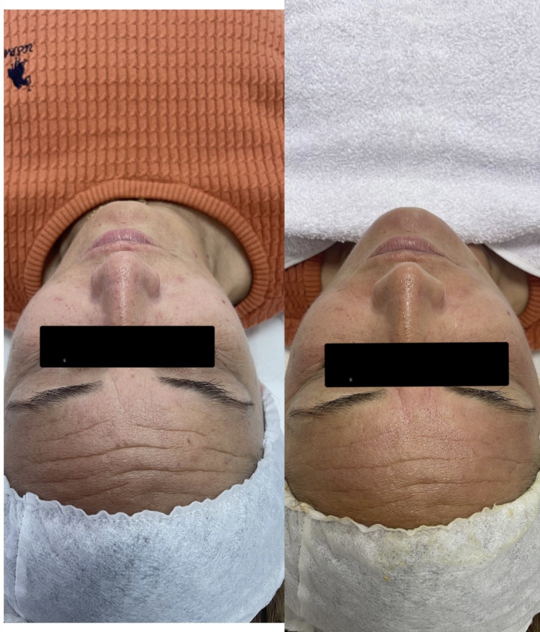 Aktivator pen casmara - Jana, Zadar Tretman lica Lice Tretman lica, Zadar, Centar