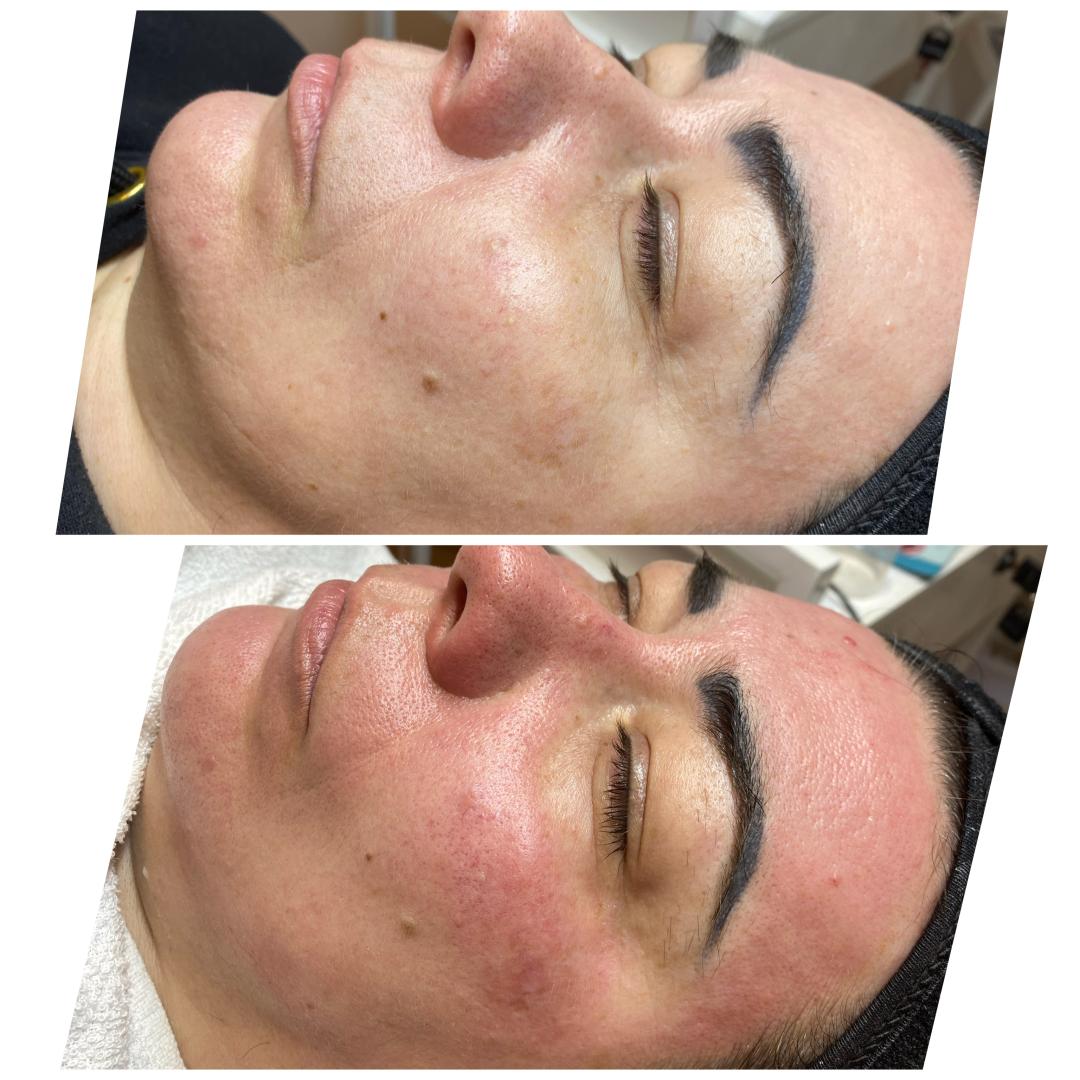 Nefertiti Studio #zagreb Mezoterapija lica Microneedling / Derma Pen lica