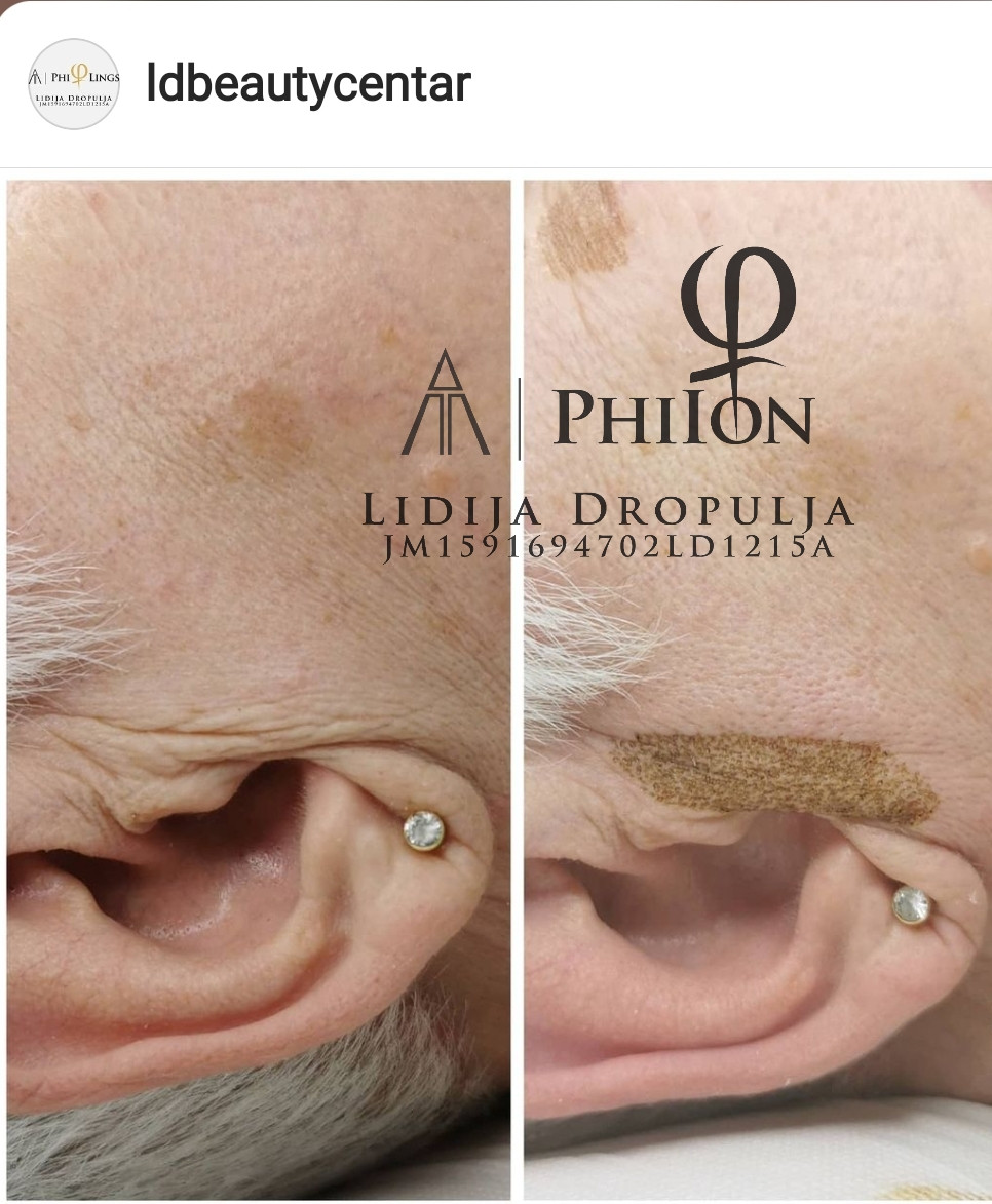 LD Beauty Centar #zagreb Tretmani protiv bora Nekiruško podizanje kapaka