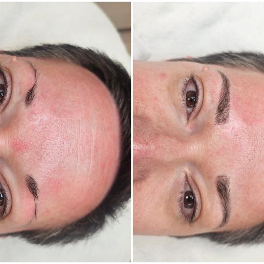 Cosmoderm & Centar Estetica #zagreb Trajna šminka Trajna šminka - iscrtavanje dlačica (hiper real