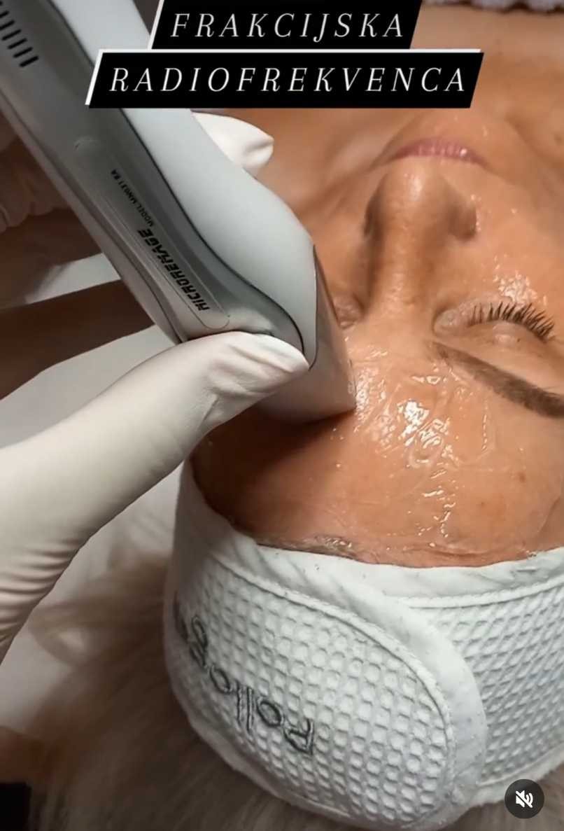Radiofrekvencija lica - tretman za podmlađivanje i zatezanje kože - Natural, Rijeka Lifting / zatezanje kože Lice Lifting / zatezanje kože, Rijeka, Centar