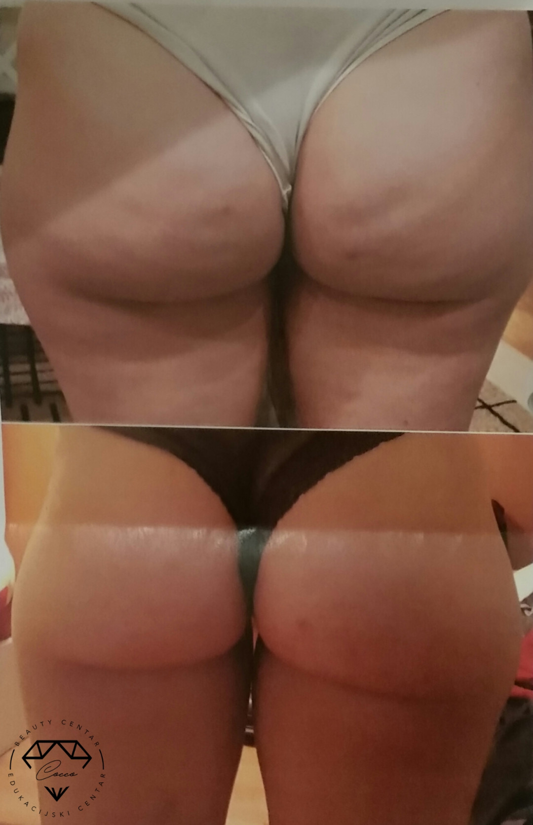 Beauty Centar By Cocco #viskovo Anticelulit masaža