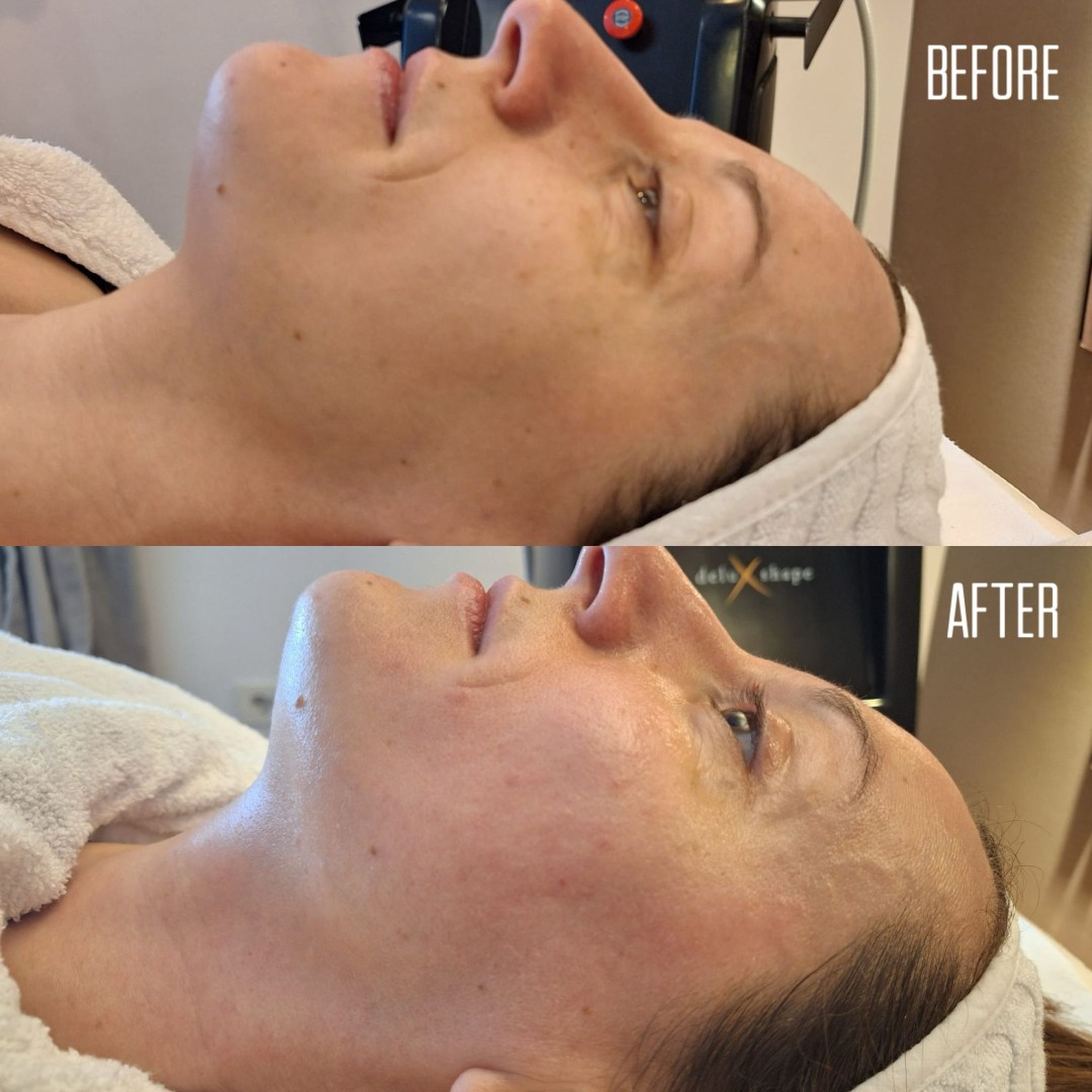 Aura #velika-gorica Tretmani tijela Deluxshape neinvazivno zatezanje lica