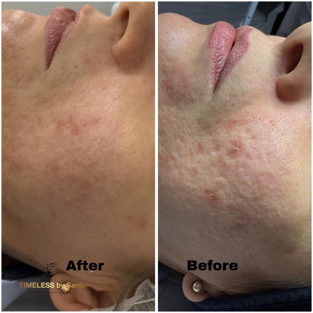 Mesoestetic peeling koktel - Timeless by Sanja, Zagreb Mezoterapija lica Lice Mezoterapija lica, Zagreb, Peščenica – Žitnjak