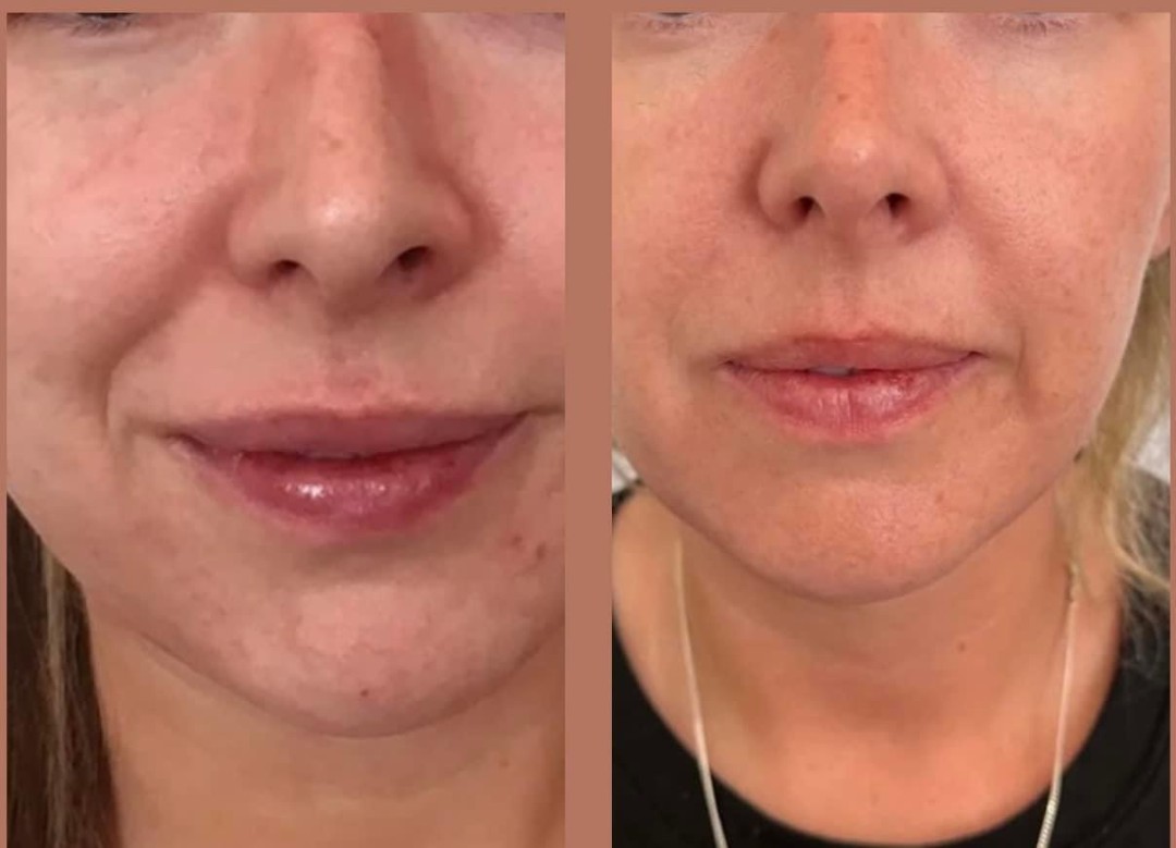 Estetix centar #zagreb Tretman lica EM-face tretman lica - paket od 4 tretmana