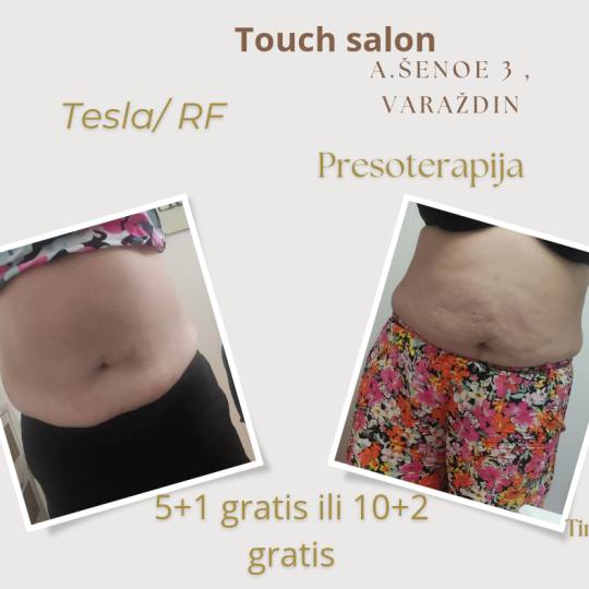 Touch #varazdin Kakvi su učinci presoterapije?
Pospješuje cirkulaciju krvi i time sprječava nast