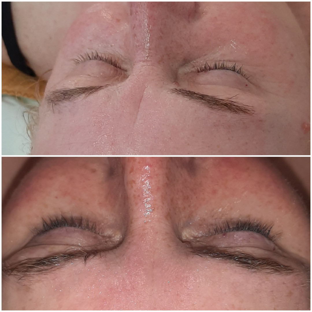 Loops #viskovo Mezoterapija lica Virtualna mezoterapija - Mesofiller