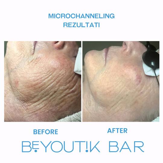 BeYoutik Bar #zagreb Tretman lica Microchanneling - lice *Napomena: Svaka koža je drugačija i potr