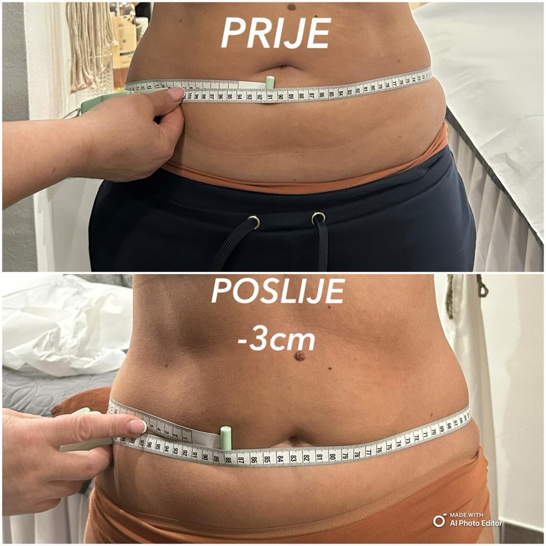 Nirvana Life Therapy #zagreb Anticelulit VelaShape V+ tretman za oblikovanje tijela