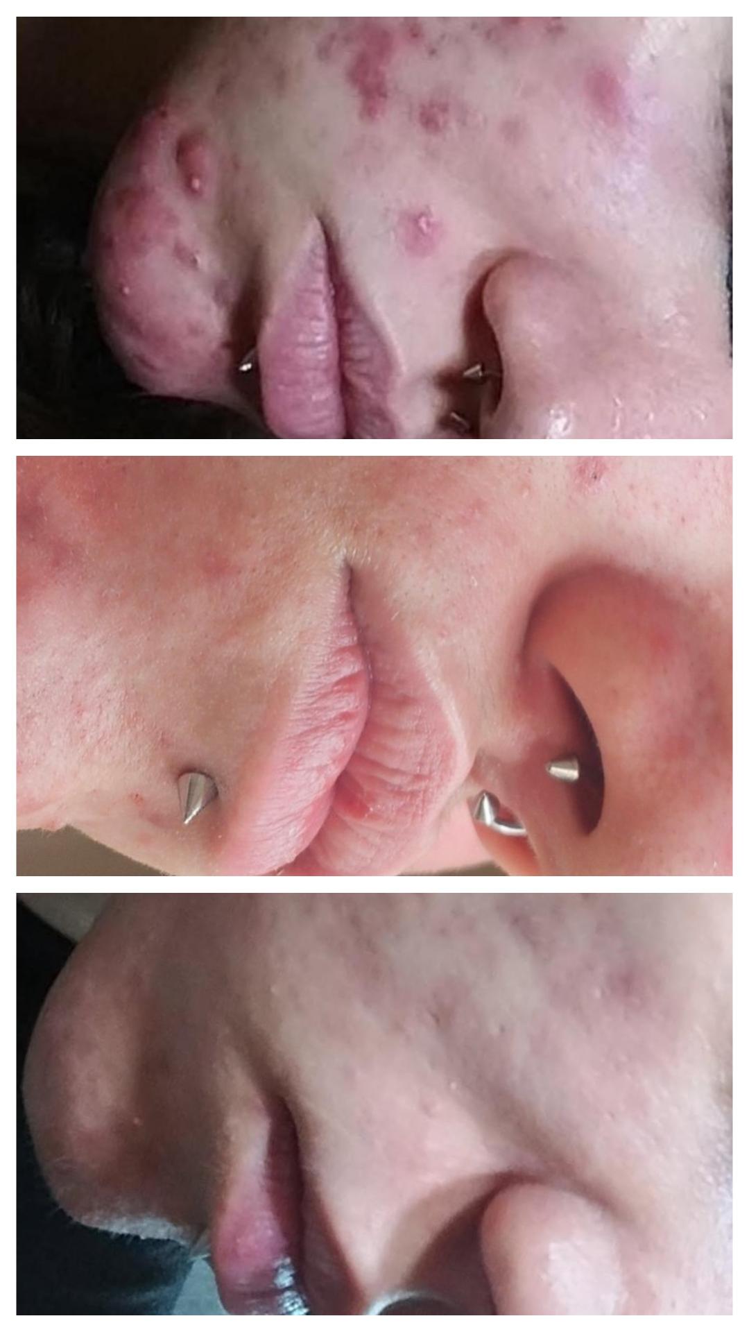 Kemijski piling - duboki - Cosmoderm & Centar Estetica, Zagreb Tretman lica Lice Tretman lica, Zagreb, Trnje