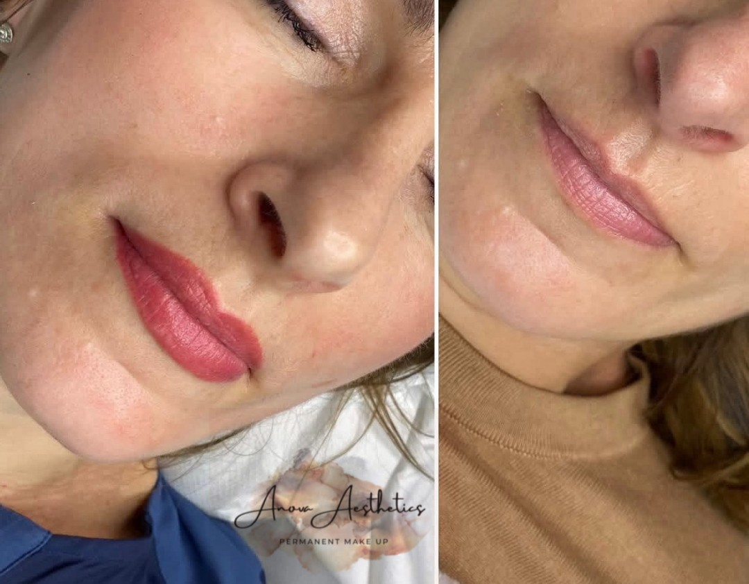 Trajna šminka - usne - Anova Aesthetics, Zagreb Trajna šminka Lice Trajna šminka, Zagreb, Trešnjevka – jug