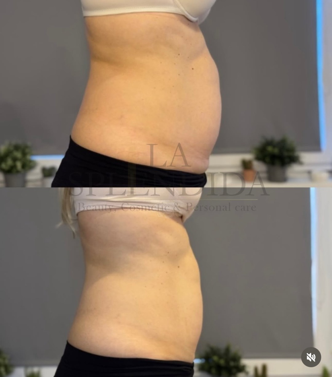 La Splendida #velika-gorica Anticelulit Ultimate Slim