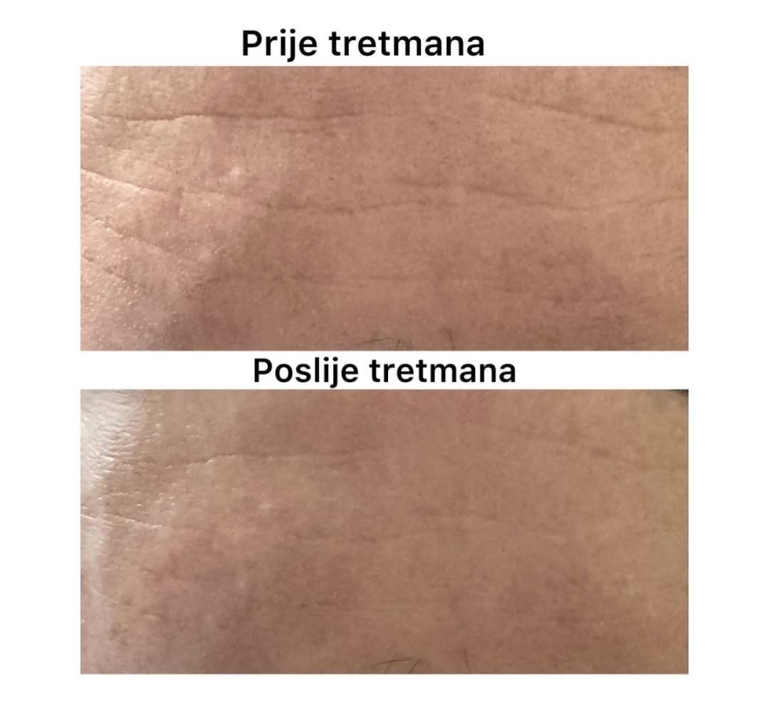 Beauty time by IM #zagreb Tretman lica Mezoterapija lica