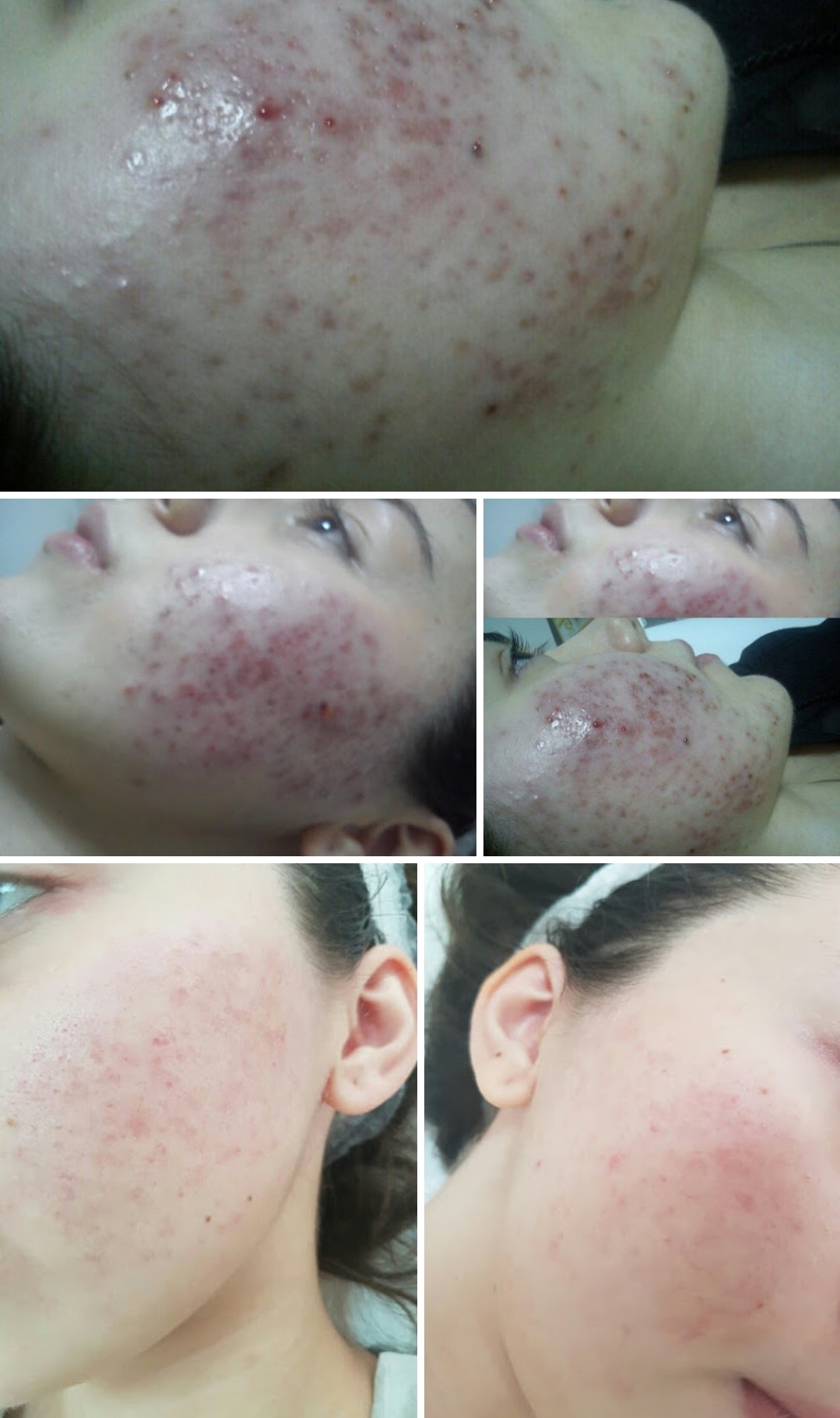 Medicinsko mehaničko čišćenje lica - problematična koža s akutnim upalnim stanjima - Cosmoderm & Centar Estetica, Zagreb Akne Lice Akne, Zagreb, Trnje