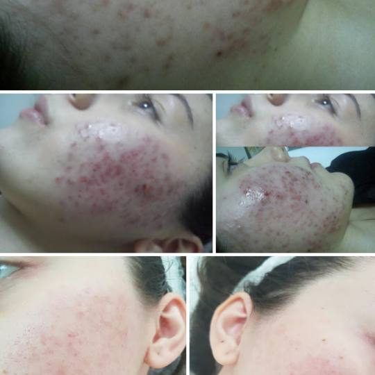Cosmoderm & Centar Estetica #zagreb Akne Medicinsko mehaničko čišćenje lica - problematična ko