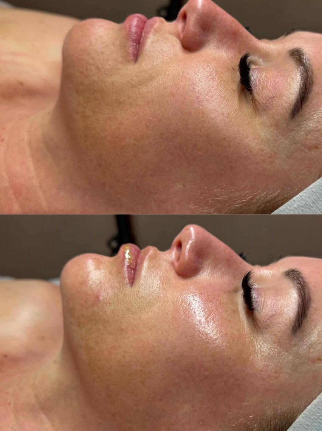 Perfect body beauty bar #zagreb Tretman lica Deluxe hydrafacial tretman lica