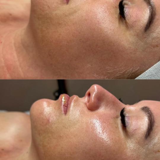 Perfect body beauty bar #zagreb Tretman lica Deluxe hydrafacial tretman lica DELUXE HYDRAFACIAL

*